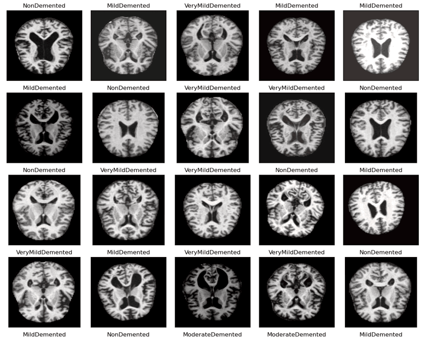 Détection de la Maladie d'Alzheimer
